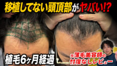 【植毛6ヶ月】頭頂部が気になる？2,600グラフト採取後の現在の状態
