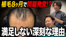 【植毛8ヶ月】欲が出てくる…！変化が大きい植毛8ヶ月後の現在の状態