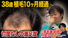 【植毛10ヶ月】2回目は？薬事情は？2,600グラフト移植を経験したリアルな感想