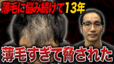 【30代で植毛】13年間悩み続けた薄毛を解消したい！現在の状態やAGA治療薬について