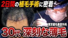 【植毛手術密着】2日間に及ぶ植毛手術の流れは？カウンセリングや手術の様子