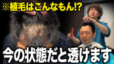 【植毛4ヶ月】本当に生えてくる…？植毛経験者の本音と現在の状態