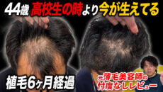 【植毛6ヶ月】前髪を上げられるようになった！植毛から半年後の状態