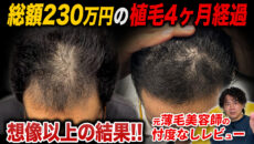 【植毛4ヶ月】総額230万円の植毛の成果は？順調？