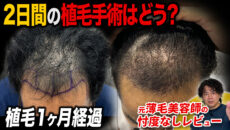 【植毛1ヶ月】2日間に及ぶ植毛手術の成果は？増毛スプレーの使い方を解説