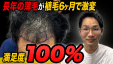 【植毛6ヶ月】増毛スプレーはもう必要ない！？現在の頭皮の状況
