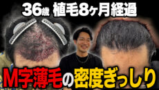 【植毛8ヶ月】帽子を被らなくてよくなった？髪の成長具合は？