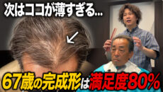 【植毛1年経過】67歳で植毛に踏み切った男性のリアルな頭皮の状態