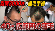【40代植毛】3,000グラフトの植毛手術に密着！カウンセリングや植毛時の様子