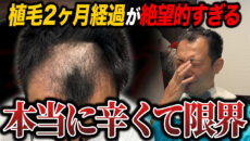 【植毛2ヶ月】どんどん髪が抜けてくる…！現在の頭皮の状態