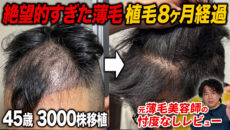 【植毛8ヶ月】密度は？生え際は？前髪を下ろしたヘアセット